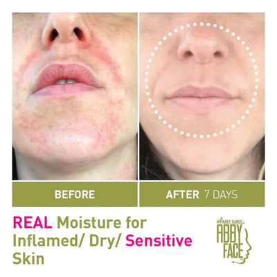 Abby™ Oil Clears Inflamed Sensitive Skin