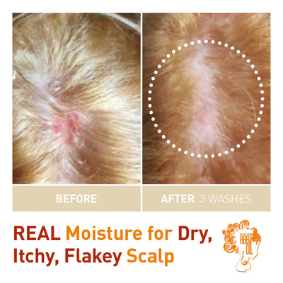 Scalp Dermatitis Abby™ Oil does wonders!